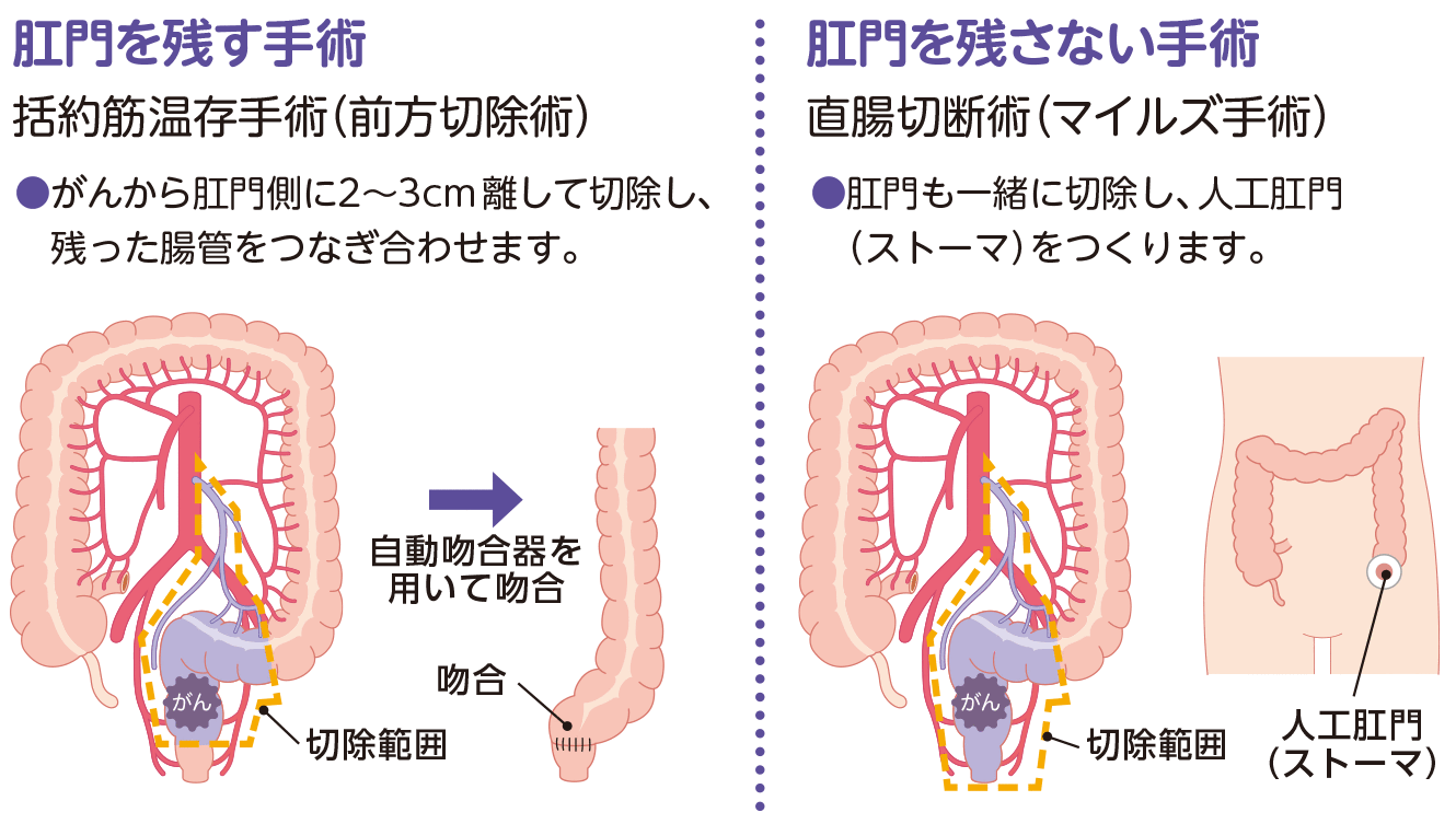 直腸がんの手術（例）