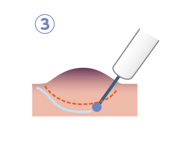病変を確実に切除するために、マーキングした部分より外側の粘膜を切ります。