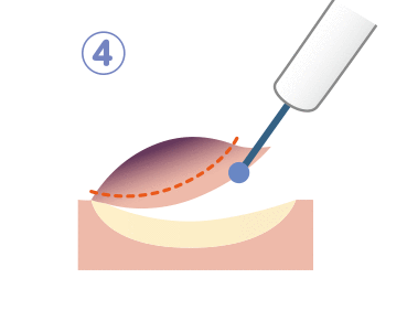 粘膜層をはぎ取るように切除し、終了後は出血や切除した状態を観察します。