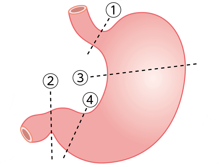 胃の切除箇所