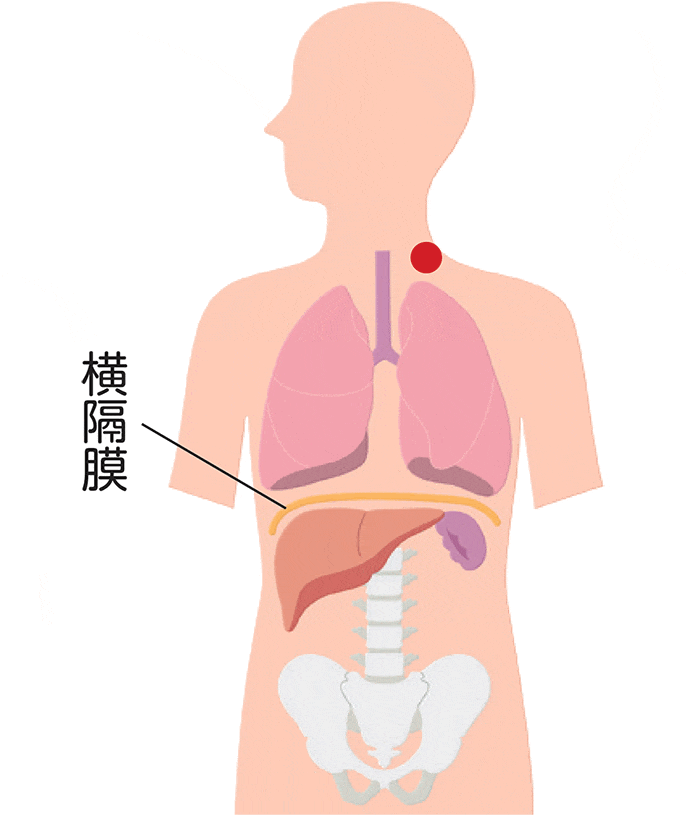 ホジキンリンパ腫の病期Ⅰ期の図