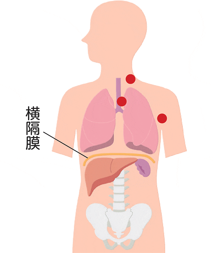 ホジキンリンパ腫の病期Ⅱ期の図