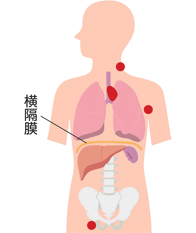 ホジキンリンパ腫の病期Ⅲ期の図