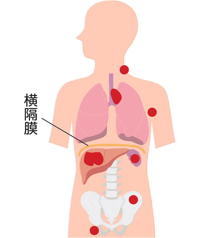 ホジキンリンパ腫の病期Ⅳ期の図
