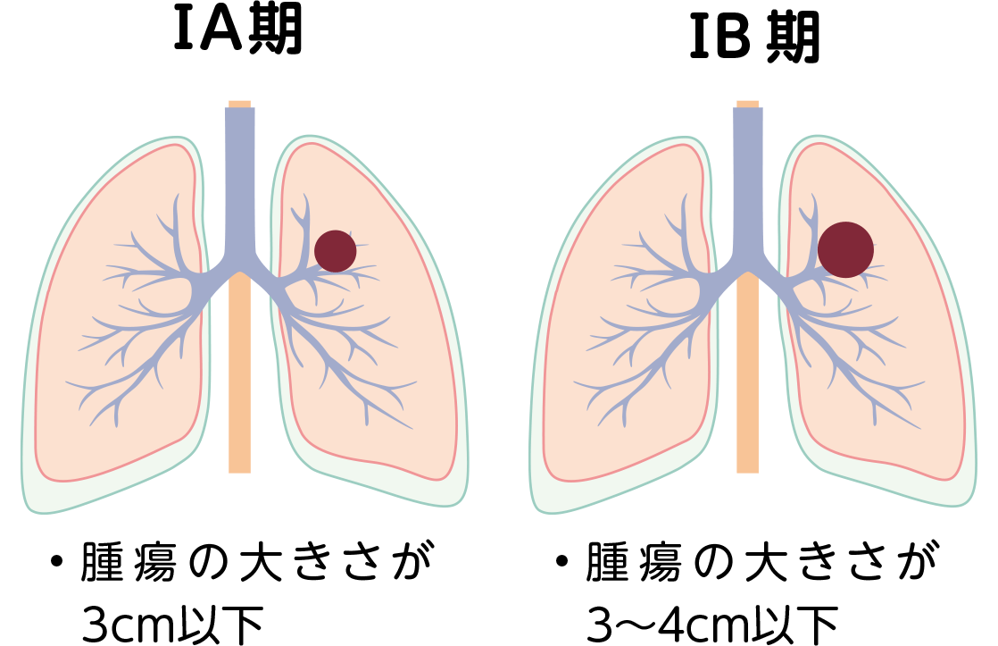 非小細胞肺がんの病期ⅠA期とⅠB期の図。ⅠA期は腫瘍の大きさが3cm以下。ⅠB期は腫瘍の大きさが3〜4cm以下。