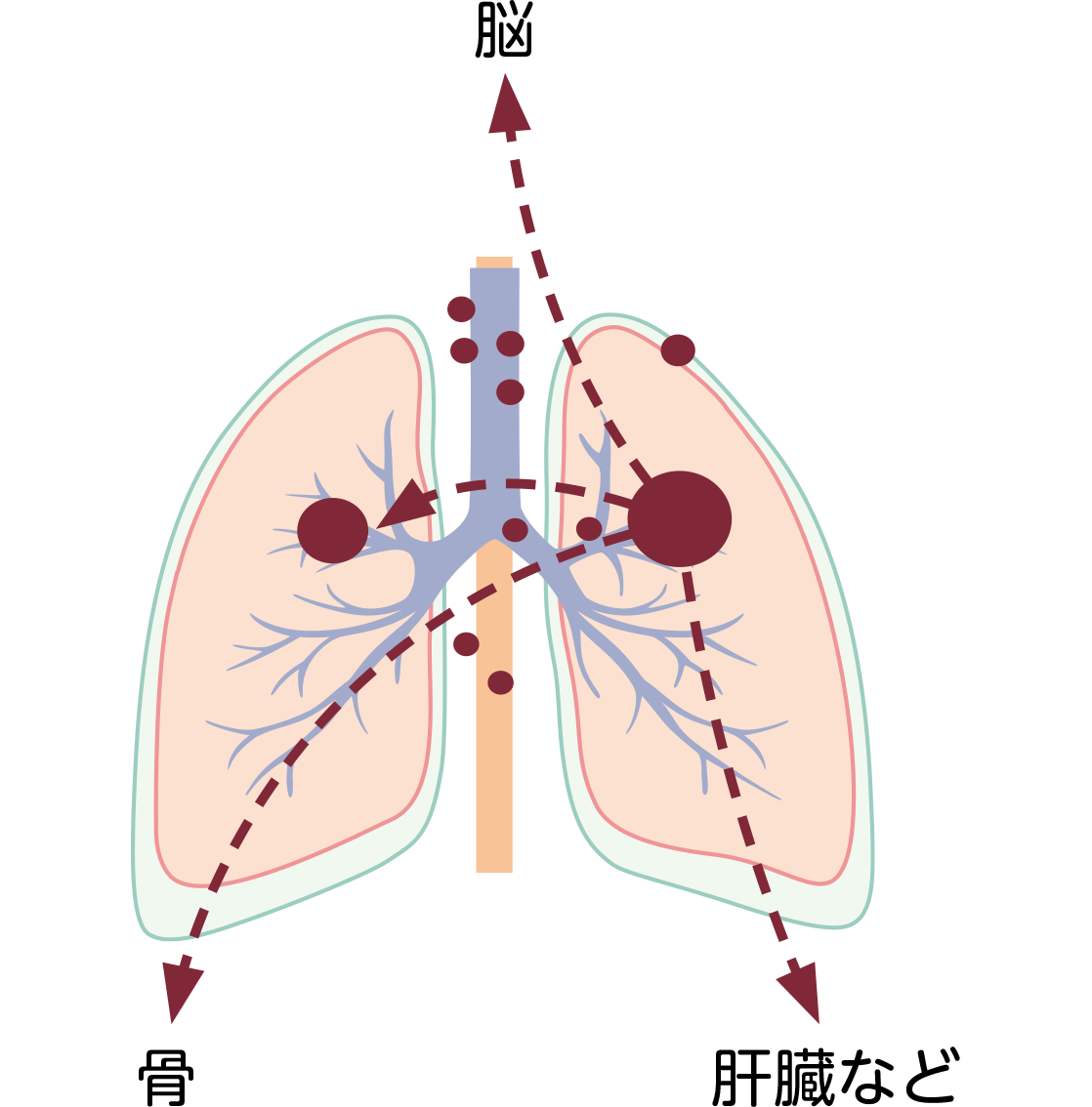 非小細胞肺がんの病期Ⅳ期の図