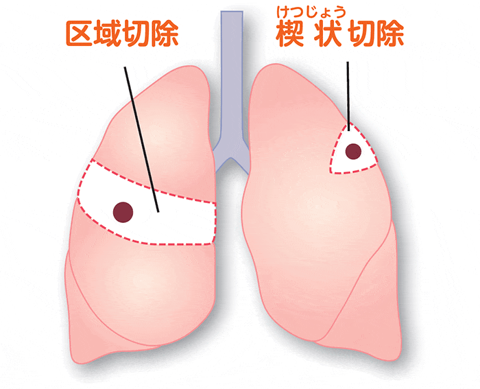 肺がんにおける縮小手術の切除範囲の図