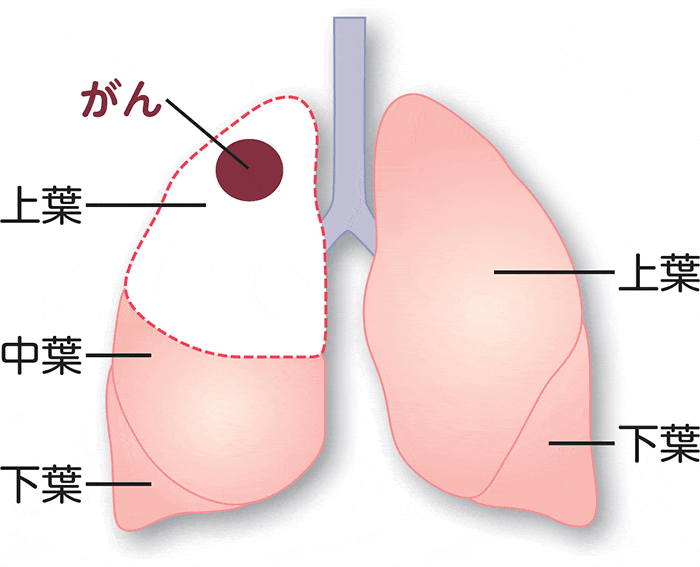 肺がんにおける肺葉切除術の切除範囲の図