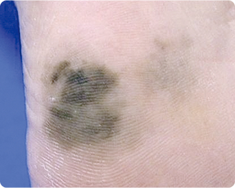 悪性黒色腫の特徴である非対称性の病変の写真