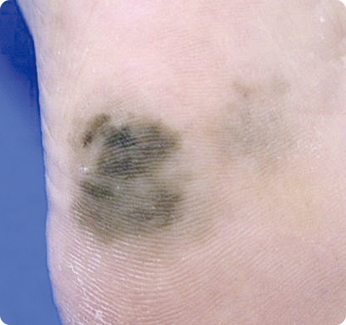 悪性黒色腫の特徴である非対称性の病変の写真