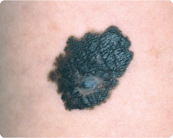 悪性黒色腫の特徴である不規則な外形の写真