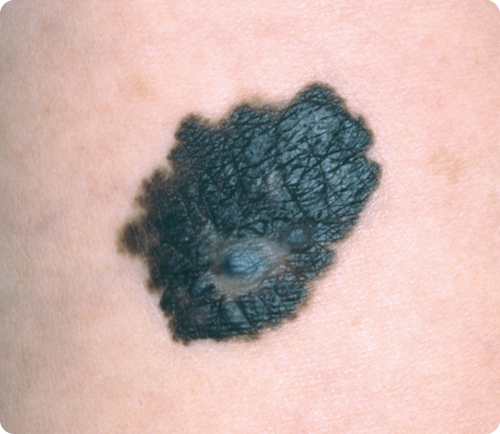 悪性黒色腫の特徴である不規則な外形の写真