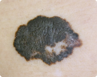 表在拡大型黒色腫の症状の写真