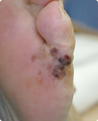 末端黒子型黒色腫の症状の写真