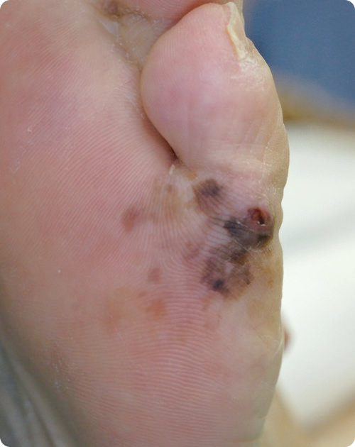 末端黒子型黒色腫の症状の写真