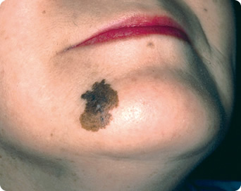 悪性黒子型黒色腫の症状の写真