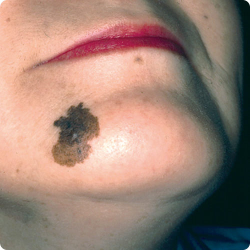 悪性黒子型黒色腫の症状の写真
