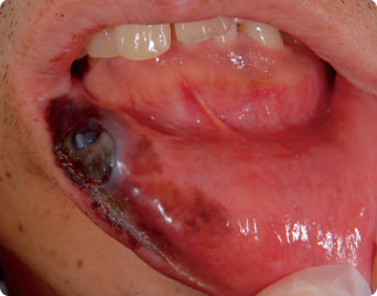 粘膜黒色腫の症状の写真