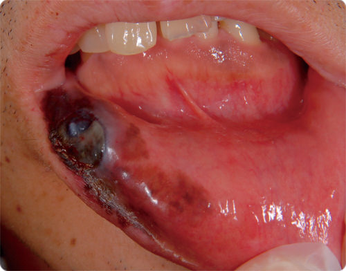 粘膜部黒色腫の症状の写真