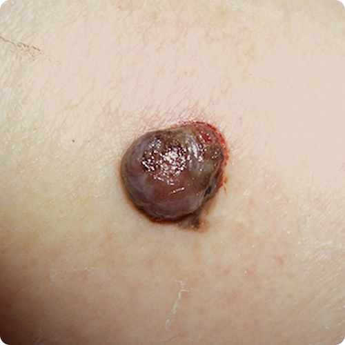 結節型黒色腫の症状の写真