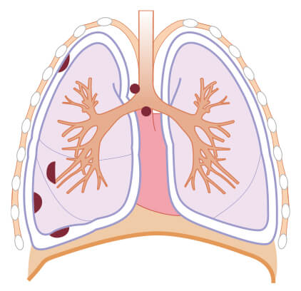 悪性胸膜中皮腫の病期 Ⅱ期の図