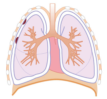 悪性胸膜中皮腫の病期 Ⅰ期A期の図