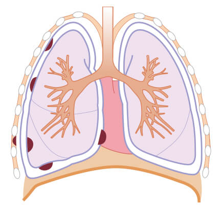 悪性胸膜中皮腫の病期 Ⅰ期B期の図