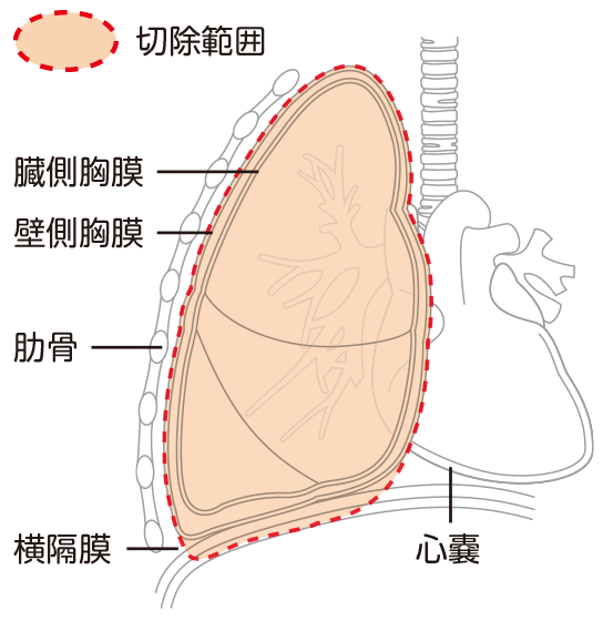 胸膜肺全摘術（EPP）