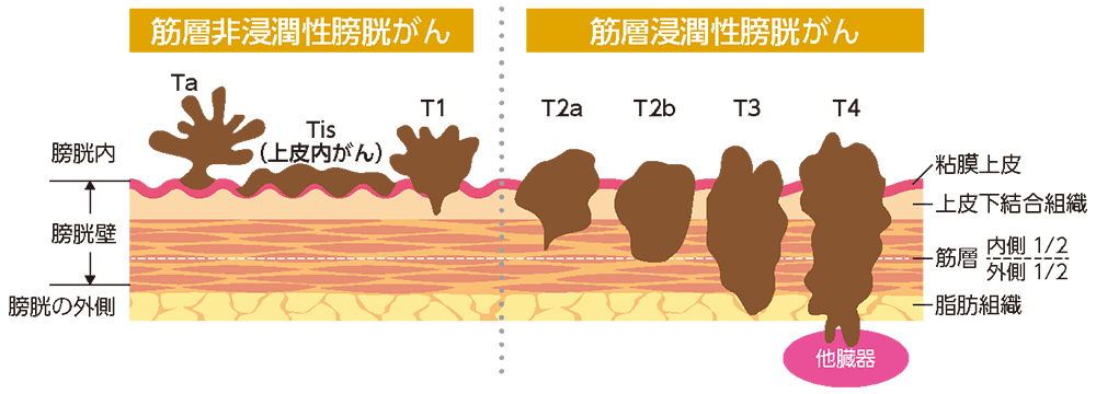 膀胱がんの深達度（T分類）