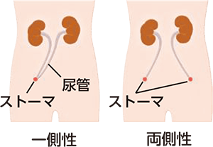 自排尿型新膀胱造設術