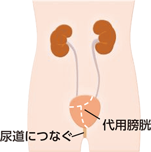 自排尿型新膀胱造設術