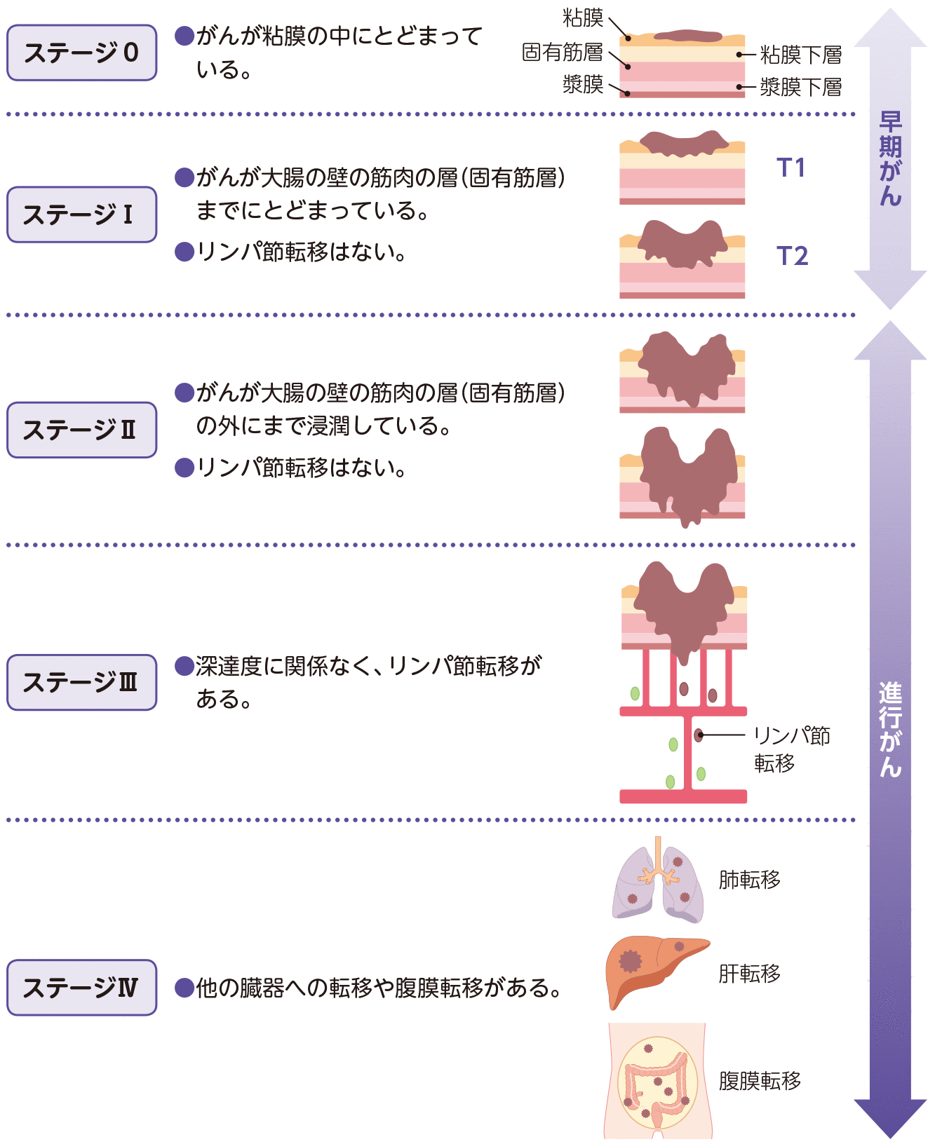 大腸がんの臨床病期（ステージ）分類