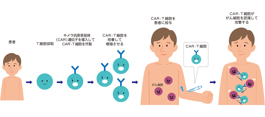 エフェクターT細胞療法（CAR-T細胞療法）